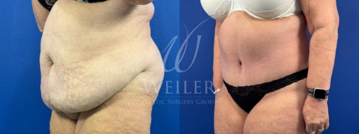 Before & After Tummy Tuck Case 1681 Left Side View in Baton Rouge, New Orleans, & Lafayette, Louisiana