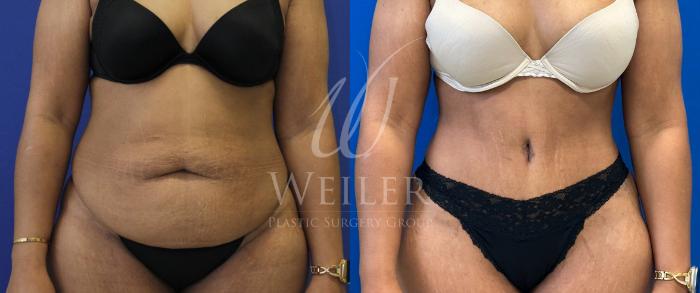 Before & After Tummy Tuck Case 1692 Front View in Baton Rouge, New Orleans, & Lafayette, Louisiana