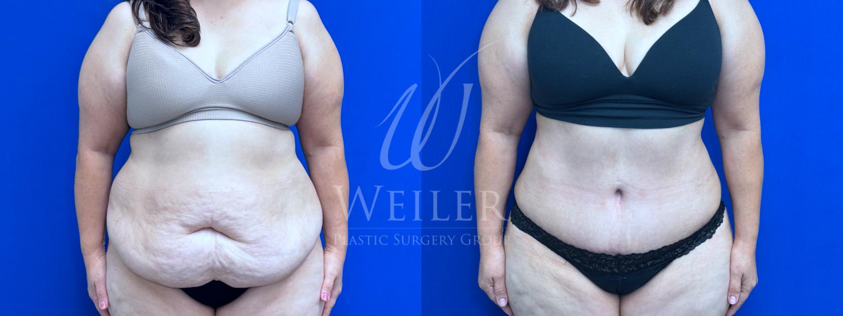 Before & After Tummy Tuck Case 1703 Front View in Baton Rouge, New Orleans, & Lafayette, Louisiana