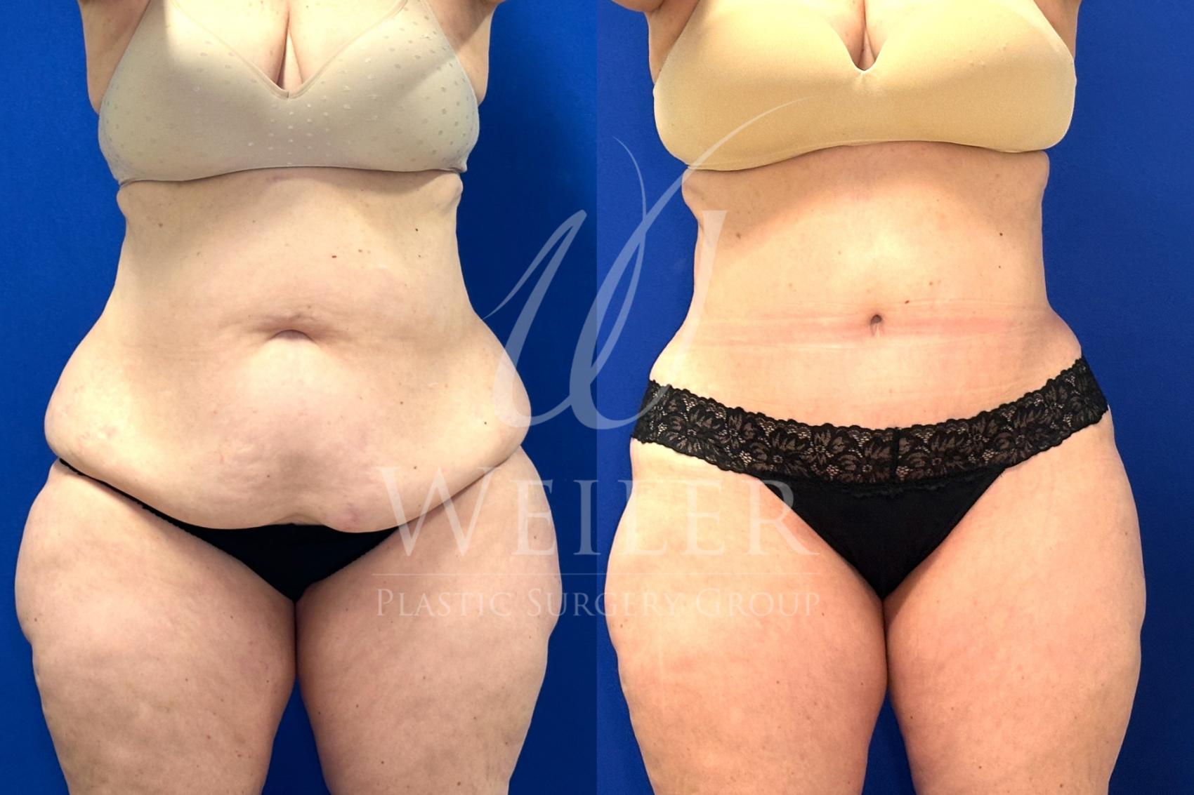 Before & After Tummy Tuck Case 1707 Front View in Baton Rouge, New Orleans, & Lafayette, Louisiana