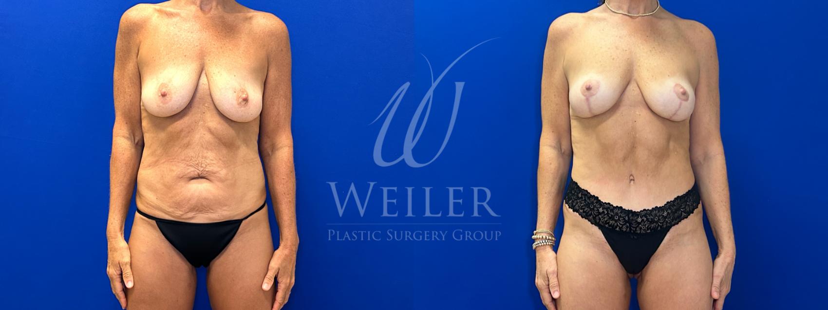 Before & After Breast Lift Case 1708 Front View in Baton Rouge, New Orleans, & Lafayette, Louisiana