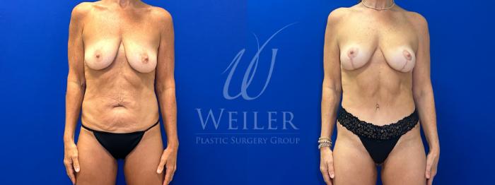 Before & After Breast Lift Case 1708 Front View in Baton Rouge, New Orleans, & Lafayette, Louisiana