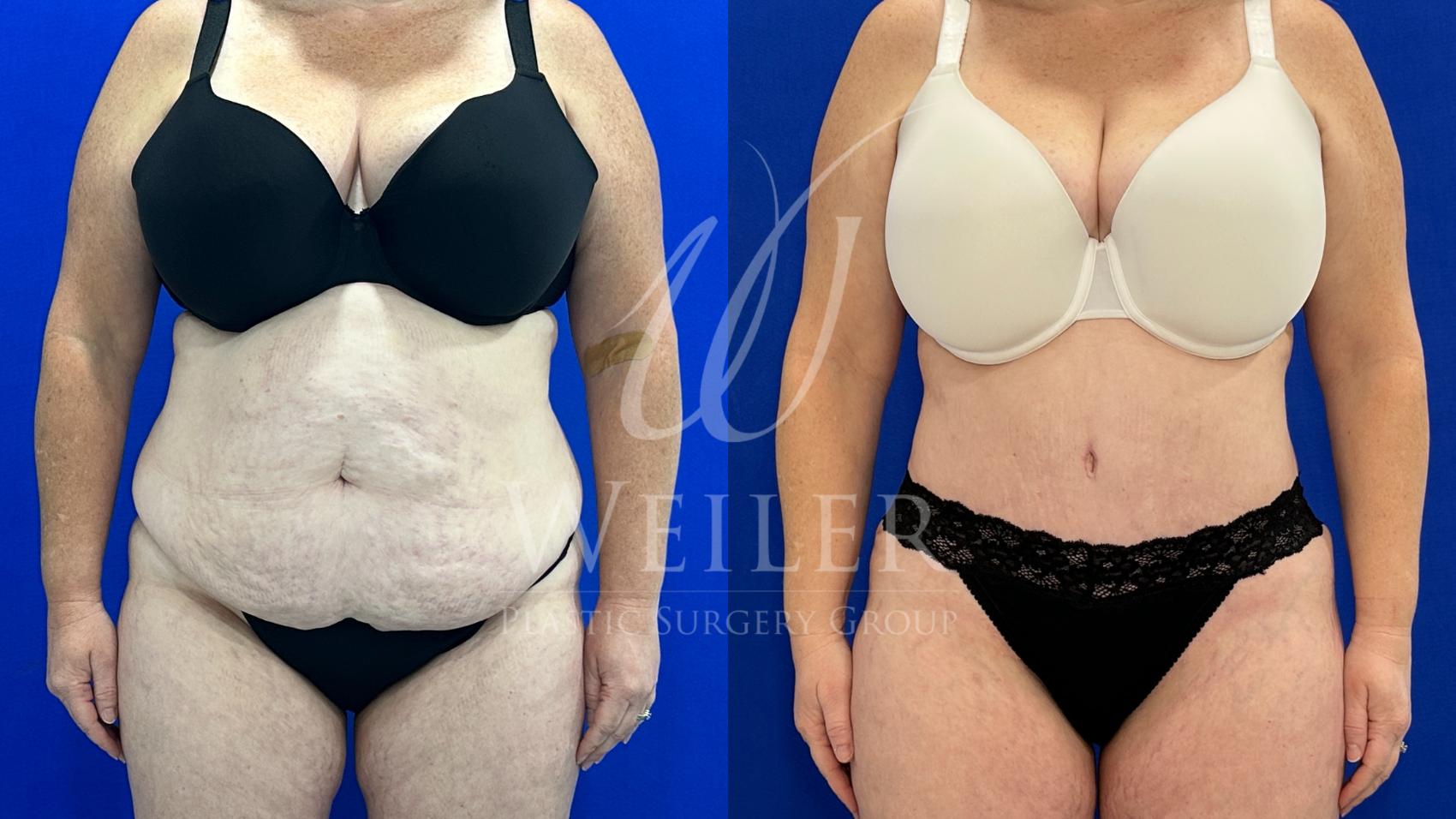 Before & After Tummy Tuck Case 1724 Front View in Baton Rouge, New Orleans, & Lafayette, Louisiana