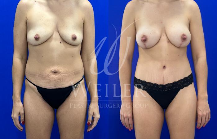 Before & After Tummy Tuck Case 1773 Front View in Baton Rouge, New Orleans, & Lafayette, Louisiana