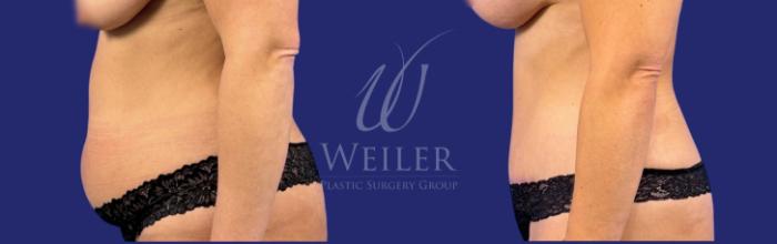 Before & After Tummy Tuck Case 1782 Left Side View in Baton Rouge, New Orleans, & Lafayette, Louisiana