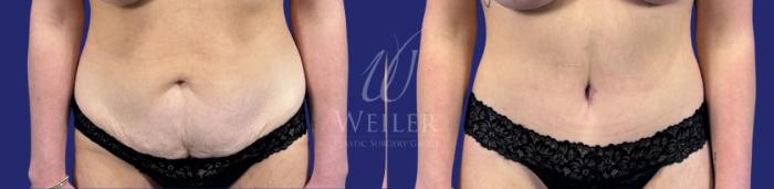 Before & After Tummy Tuck Case 1785 Front View in Baton Rouge, New Orleans, & Lafayette, Louisiana