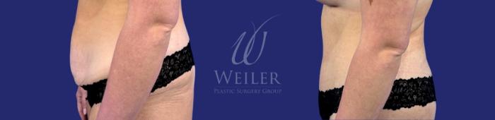 Before & After Tummy Tuck Case 1785 Left Side View in Baton Rouge, New Orleans, & Lafayette, Louisiana