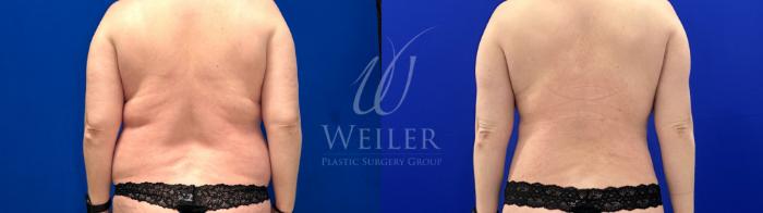 Before & After Tummy Tuck Case 1792 Back View in Baton Rouge, New Orleans, & Lafayette, Louisiana