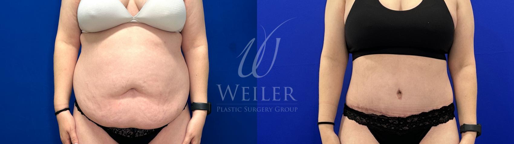 Before & After Tummy Tuck Case 1792 Front View in Baton Rouge, New Orleans, & Lafayette, Louisiana