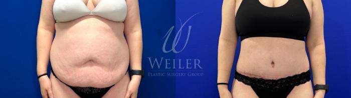 Before & After Tummy Tuck Case 1792 Front View in Baton Rouge, New Orleans, & Lafayette, Louisiana