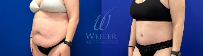 Before & After Tummy Tuck Case 1792 Left Oblique View in Baton Rouge, New Orleans, & Lafayette, Louisiana