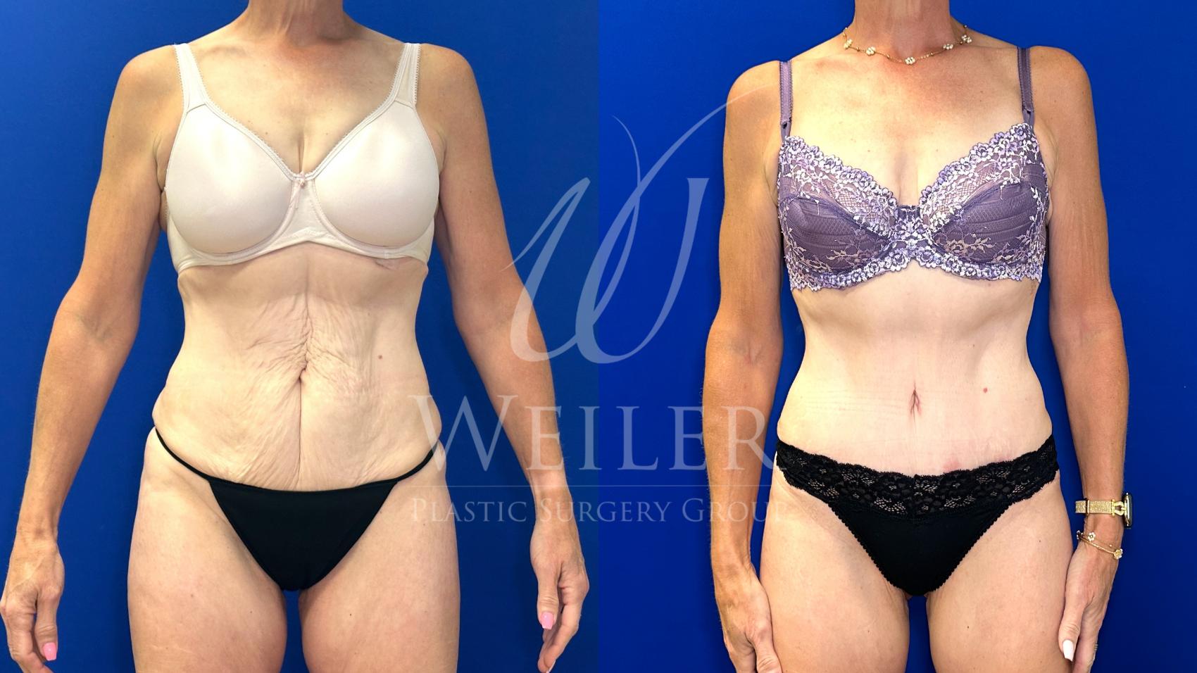 Before & After Tummy Tuck Case 1794 Front View in Baton Rouge, New Orleans, & Lafayette, Louisiana
