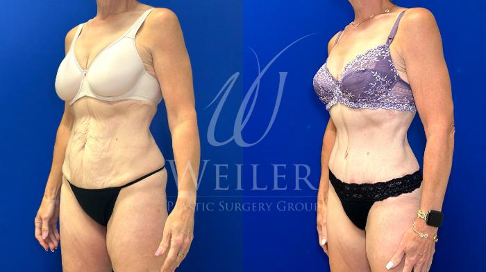 Before & After Tummy Tuck Case 1794 Left Oblique View in Baton Rouge, New Orleans, & Lafayette, Louisiana