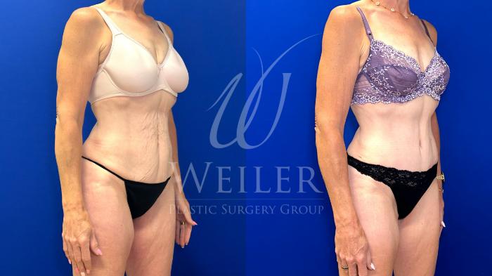 Before & After Tummy Tuck Case 1794 Right Oblique View in Baton Rouge, New Orleans, & Lafayette, Louisiana
