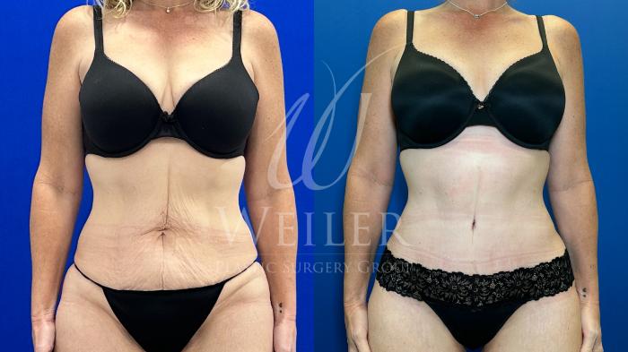 Before & After Tummy Tuck Case 1795 Front View in Baton Rouge, New Orleans, & Lafayette, Louisiana