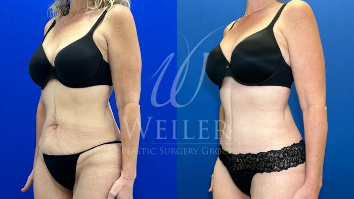 Before & After Tummy Tuck Case 1795 Left Oblique View in Baton Rouge, New Orleans, & Lafayette, Louisiana
