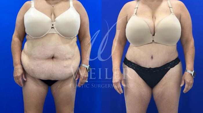 Before & After Tummy Tuck Case 1796 Front View in Baton Rouge, New Orleans, & Lafayette, Louisiana