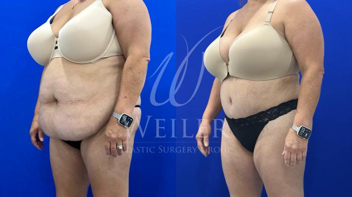Before & After Tummy Tuck Case 1796 Left Oblique View in Baton Rouge, New Orleans, & Lafayette, Louisiana