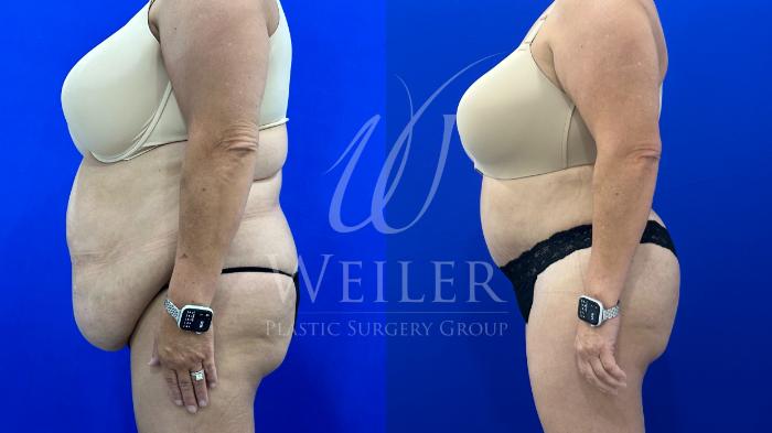 Before & After Tummy Tuck Case 1796 Left Side View in Baton Rouge, New Orleans, & Lafayette, Louisiana