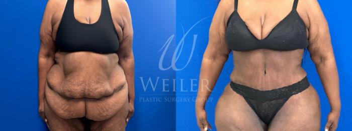 Before & After Tummy Tuck Case 1797 Front View in Baton Rouge, New Orleans, & Lafayette, Louisiana