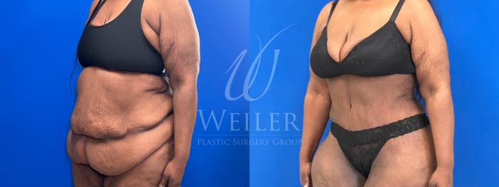 Before & After Tummy Tuck Case 1797 Left Oblique View in Baton Rouge, New Orleans, & Lafayette, Louisiana