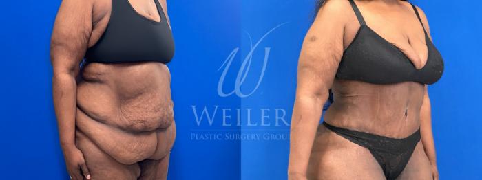 Before & After Tummy Tuck Case 1797 Right Oblique View in Baton Rouge, New Orleans, & Lafayette, Louisiana