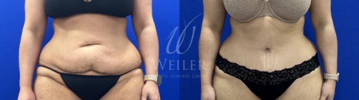 Before & After Tummy Tuck Case 1824 Front View in Baton Rouge, New Orleans, & Lafayette, Louisiana