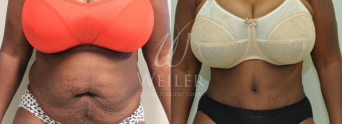 Before & After Tummy Tuck Case 210 View #1 View in Baton Rouge, New Orleans, & Lafayette, Louisiana
