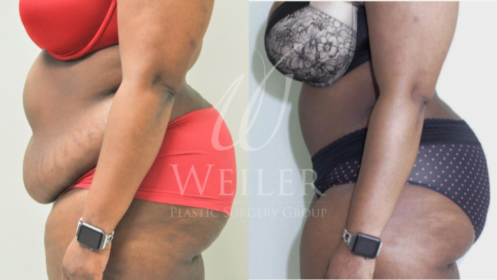 Before & After Tummy Tuck Case 255 View #1 View in Baton Rouge, New Orleans, & Lafayette, Louisiana