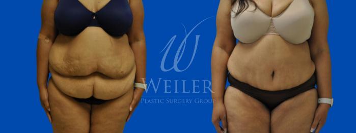 Before & After Tummy Tuck Case 273 View #1 View in Baton Rouge, New Orleans, & Lafayette, Louisiana