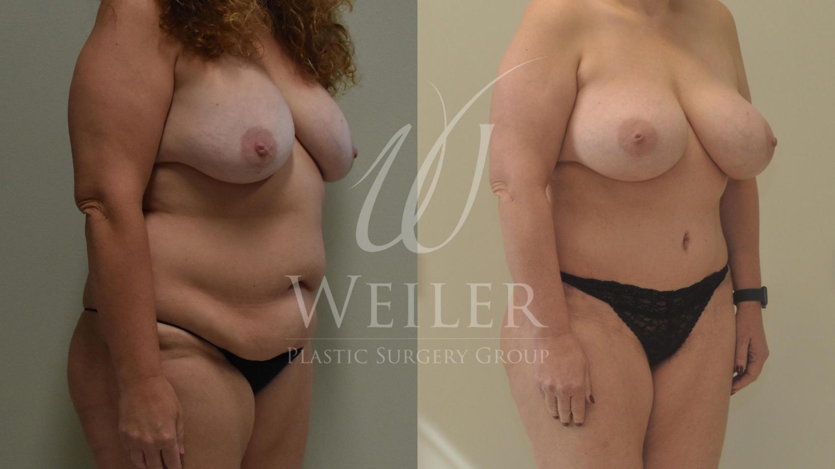 Before & After Tummy Tuck Case 314 View #1 View in Baton Rouge, New Orleans, & Lafayette, Louisiana