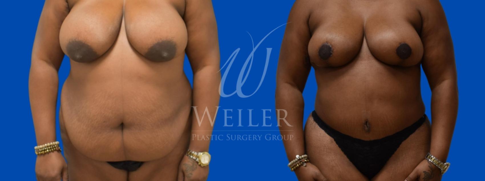 Before & After Tummy Tuck Case 318 Front View in Baton Rouge, Louisiana