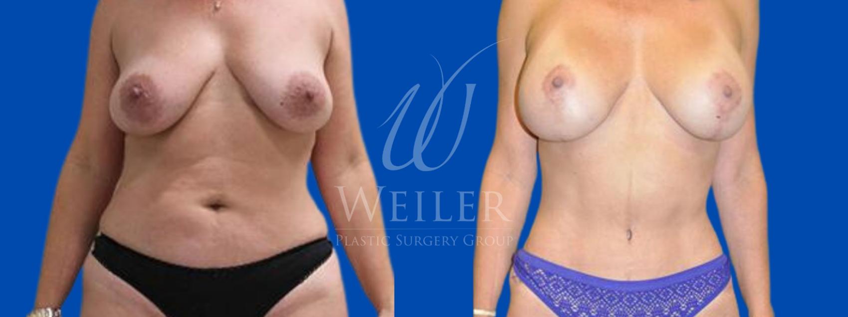 Before & After Tummy Tuck Case 322 View #1 View in Baton Rouge, New Orleans, & Lafayette, Louisiana