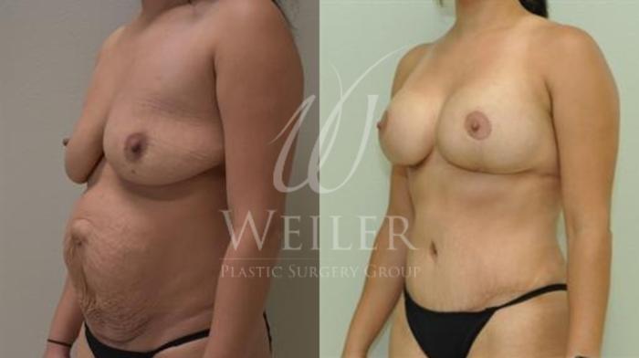 Before & After Tummy Tuck Case 327 View #1 View in Baton Rouge, New Orleans, & Lafayette, Louisiana
