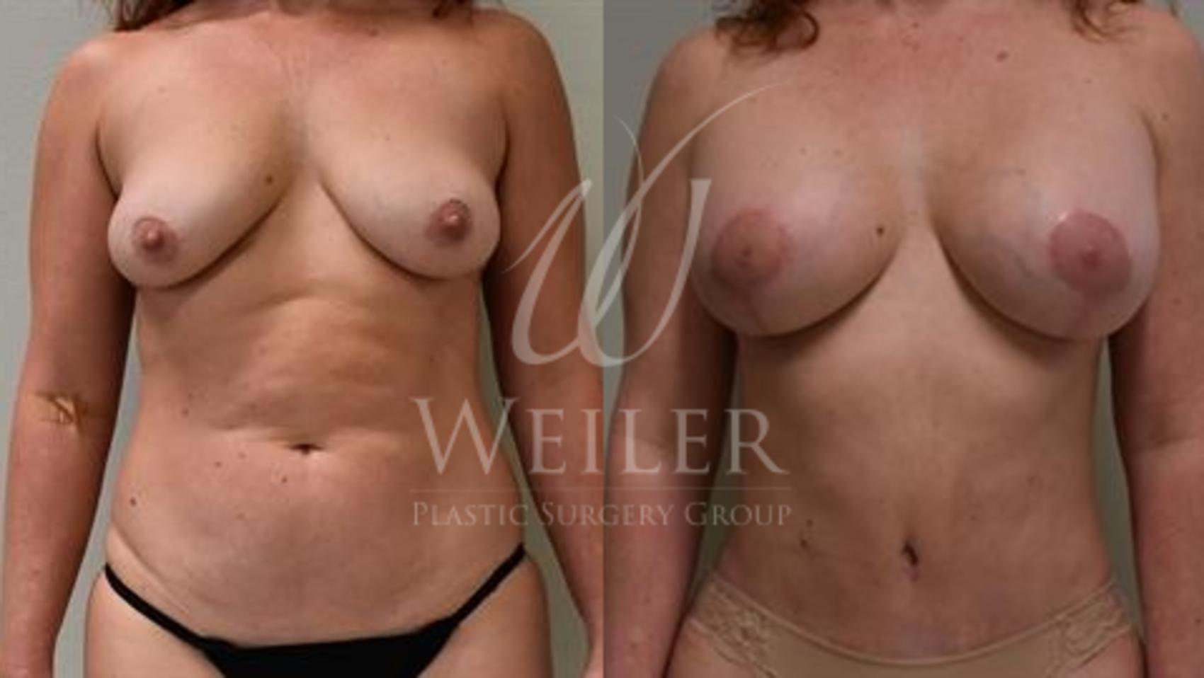 Before & After Tummy Tuck Case 331 View #1 View in Baton Rouge, New Orleans, & Lafayette, Louisiana