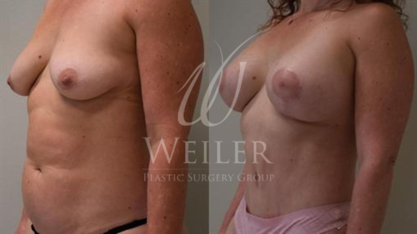 Before & After Tummy Tuck Case 340 View #1 View in Baton Rouge, New Orleans, & Lafayette, Louisiana