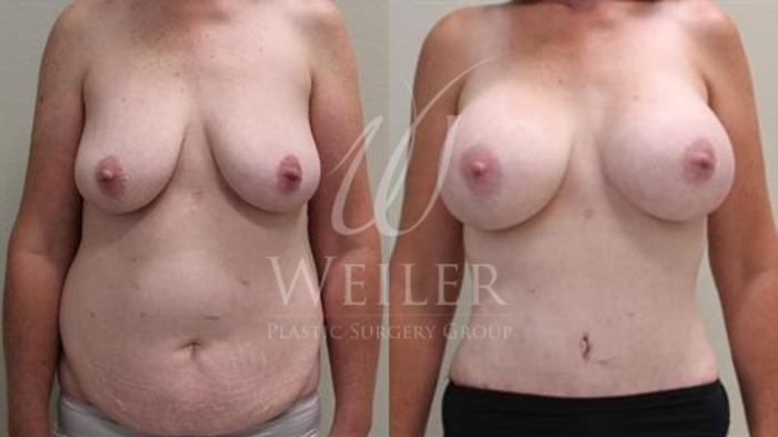Before & After Tummy Tuck Case 346 View #1 View in Baton Rouge, New Orleans, & Lafayette, Louisiana