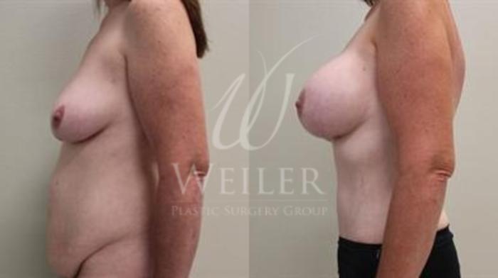 Before & After Tummy Tuck Case 346 View #2 View in Baton Rouge, New Orleans, & Lafayette, Louisiana