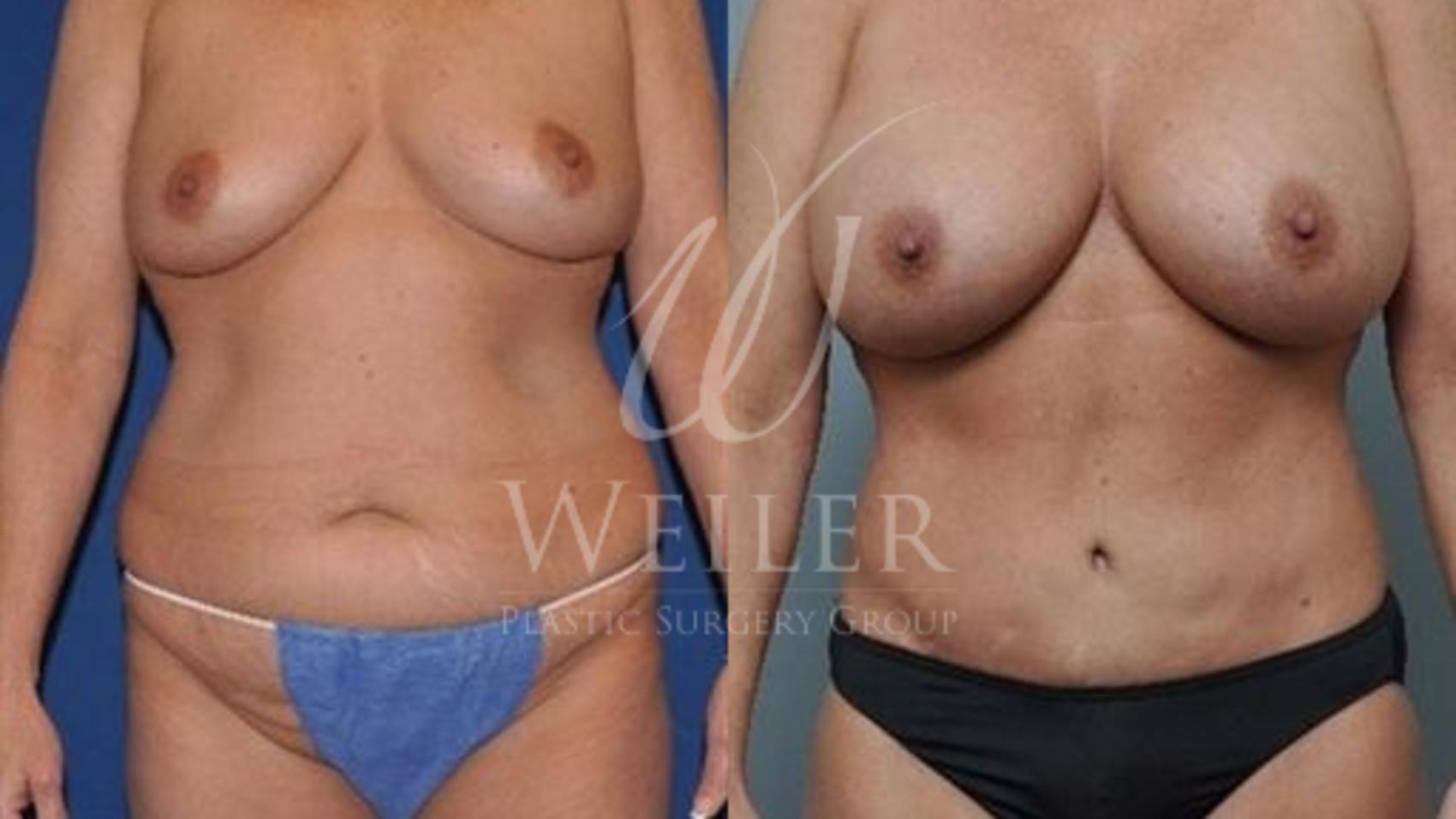 Before & After Tummy Tuck Case 348 View #1 View in Baton Rouge, New Orleans, & Lafayette, Louisiana