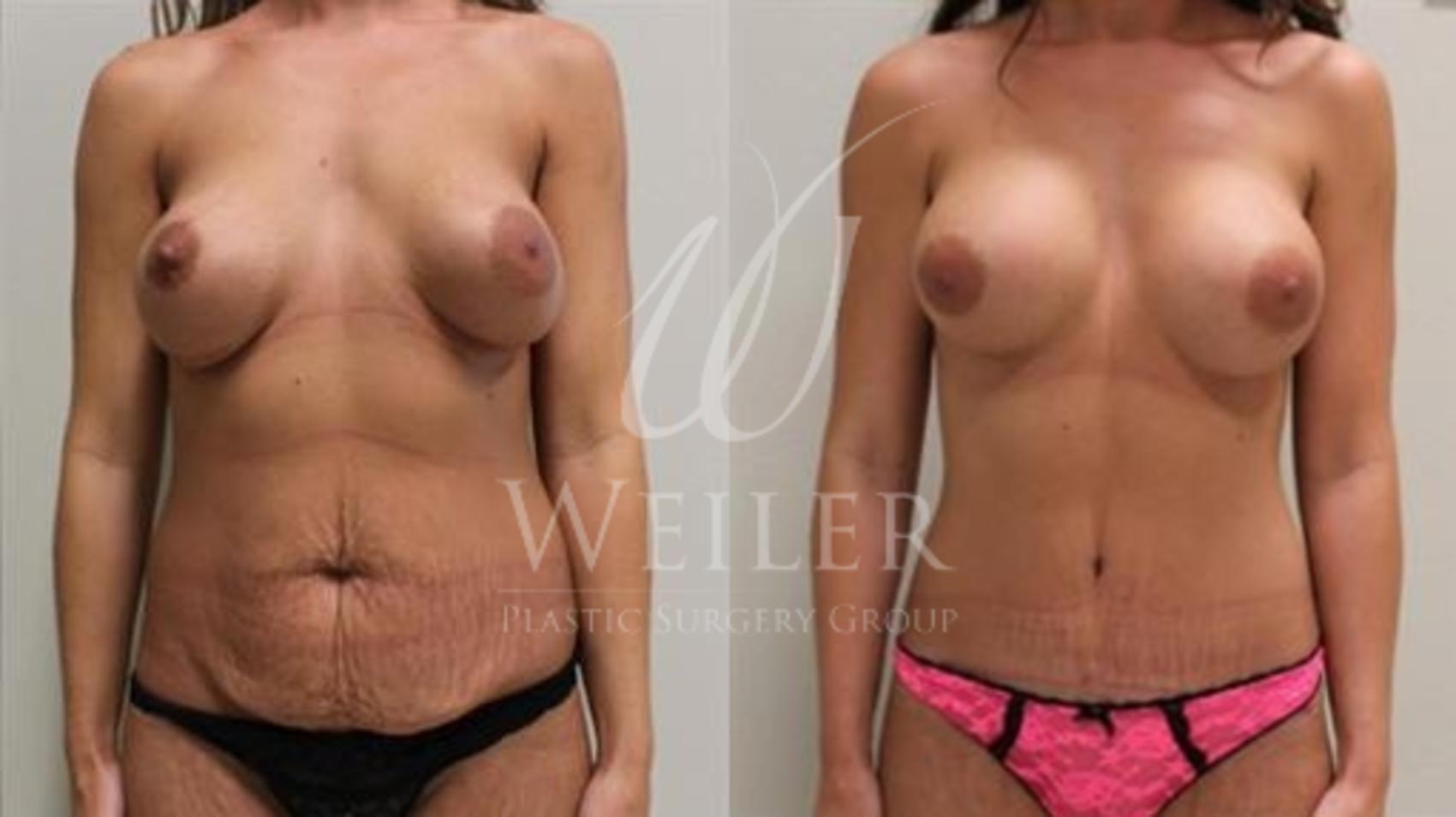 Before & After Tummy Tuck Case 350 View #1 View in Baton Rouge, Louisiana