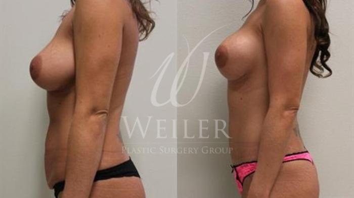 Before & After Tummy Tuck Case 350 View #2 View in Baton Rouge, Louisiana