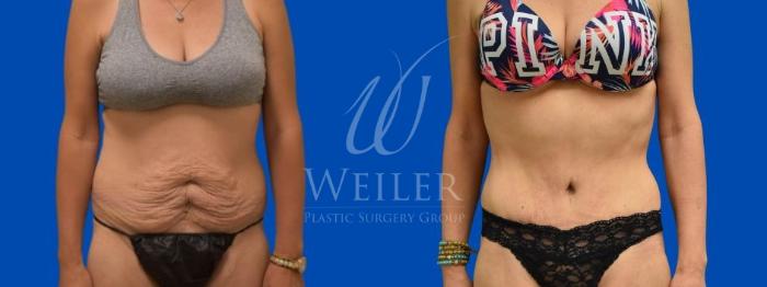 Before & After Tummy Tuck Case 360 View #1 View in Baton Rouge, Louisiana