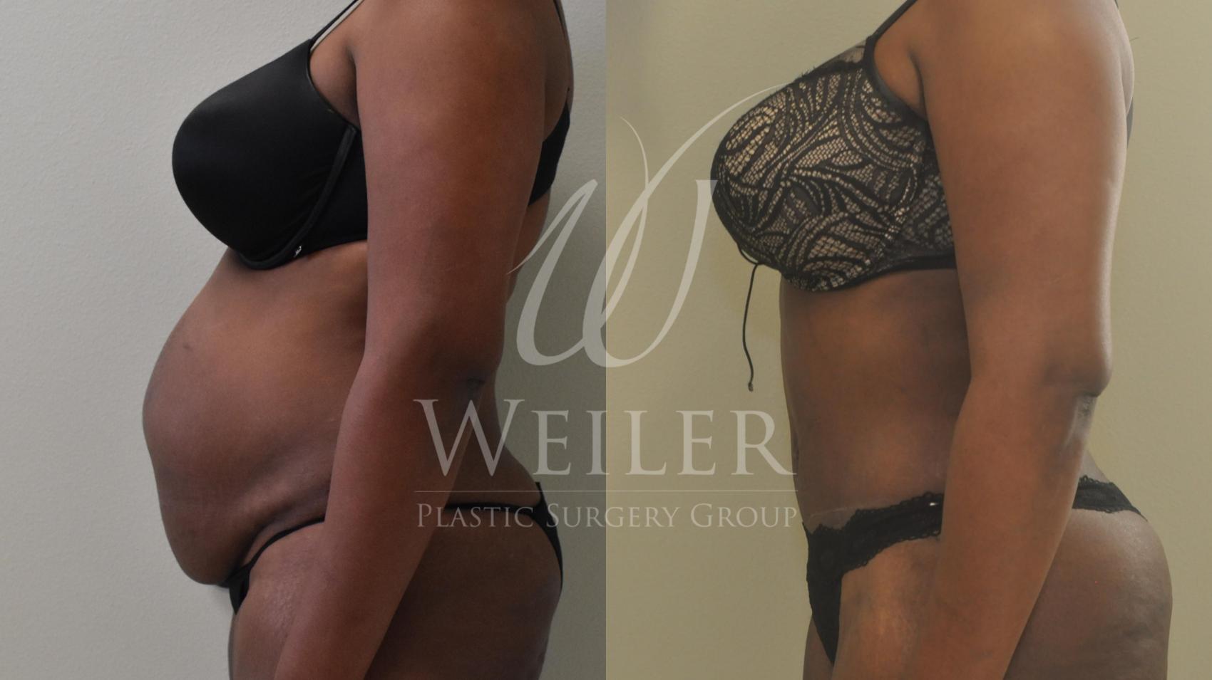 Before & After Tummy Tuck Case 368 View #1 View in Baton Rouge, Louisiana