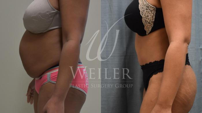 Before & After Tummy Tuck Case 369 View #1 View in Baton Rouge, Louisiana