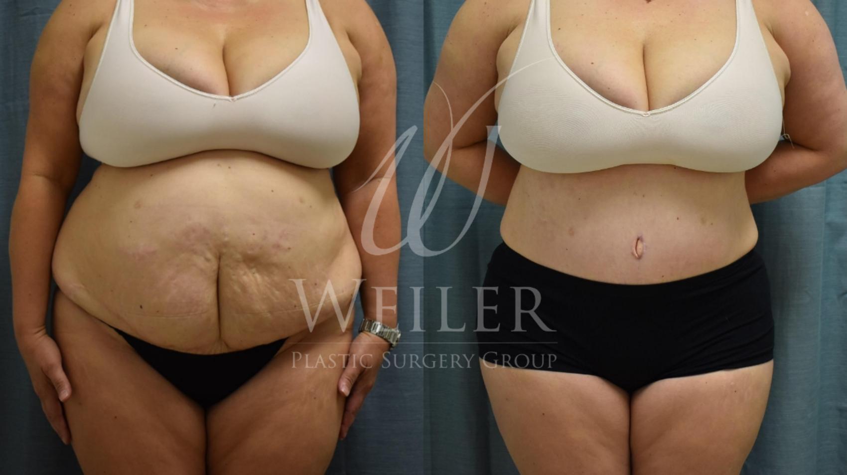 Before & After Tummy Tuck Case 370 View #1 View in Baton Rouge, New Orleans, & Lafayette, Louisiana