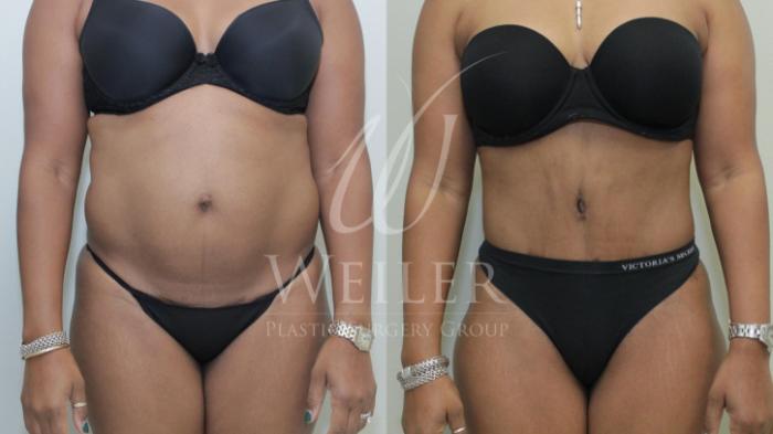 Before & After Tummy Tuck Case 379 View #1 View in Baton Rouge, New Orleans, & Lafayette, Louisiana