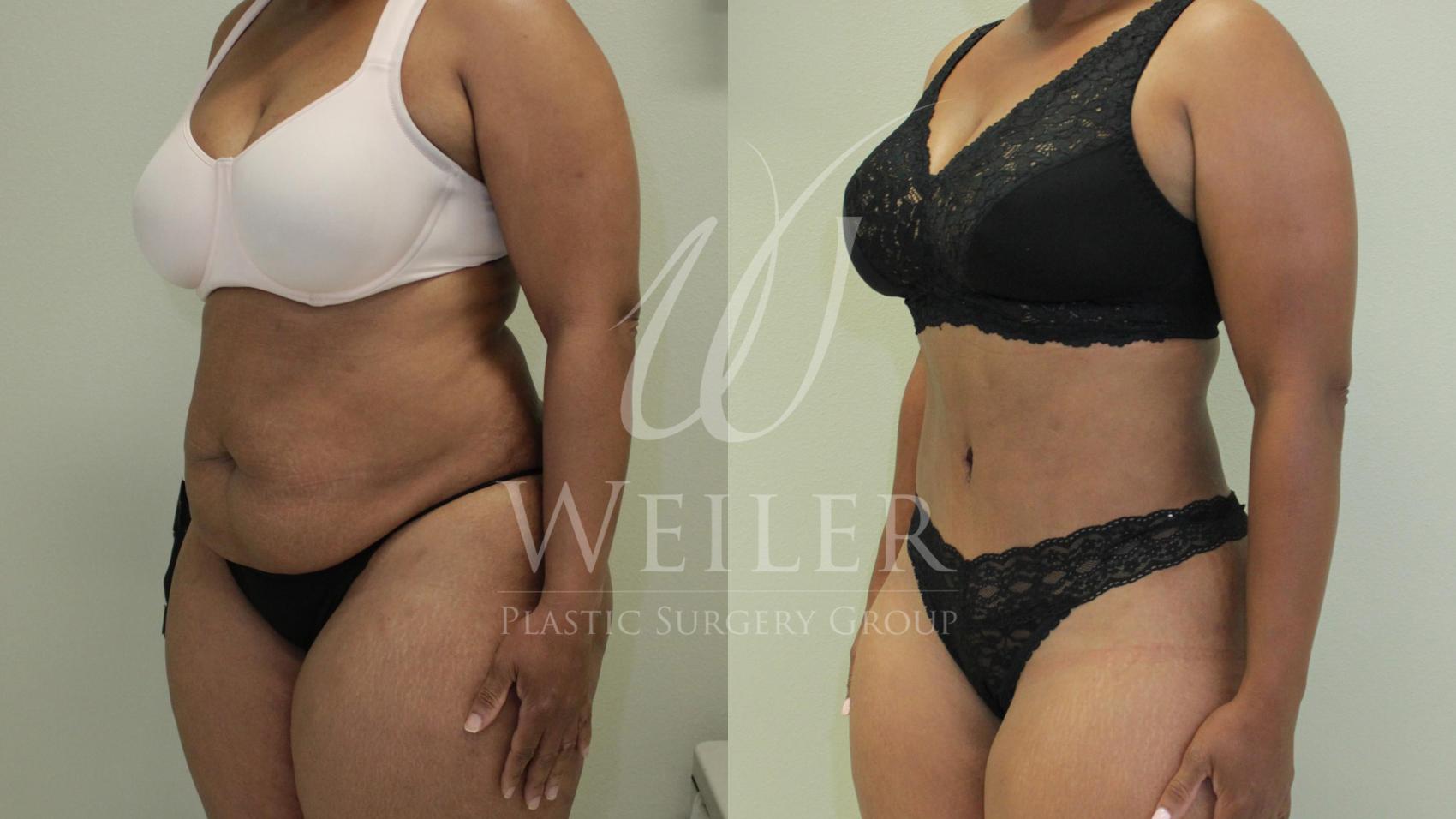 Before & After Tummy Tuck Case 440 View #1 View in Baton Rouge, Louisiana