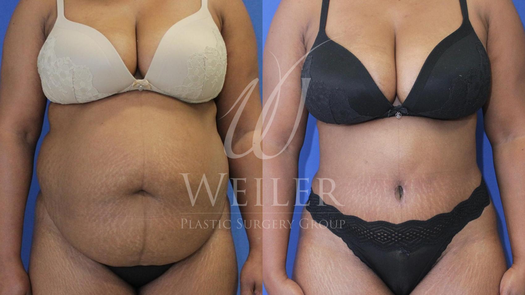 Before & After Tummy Tuck Case 449 View #1 View in Baton Rouge, Louisiana
