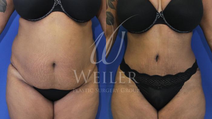 Before & After Tummy Tuck Case 453 View #1 View in Baton Rouge, New Orleans, & Lafayette, Louisiana