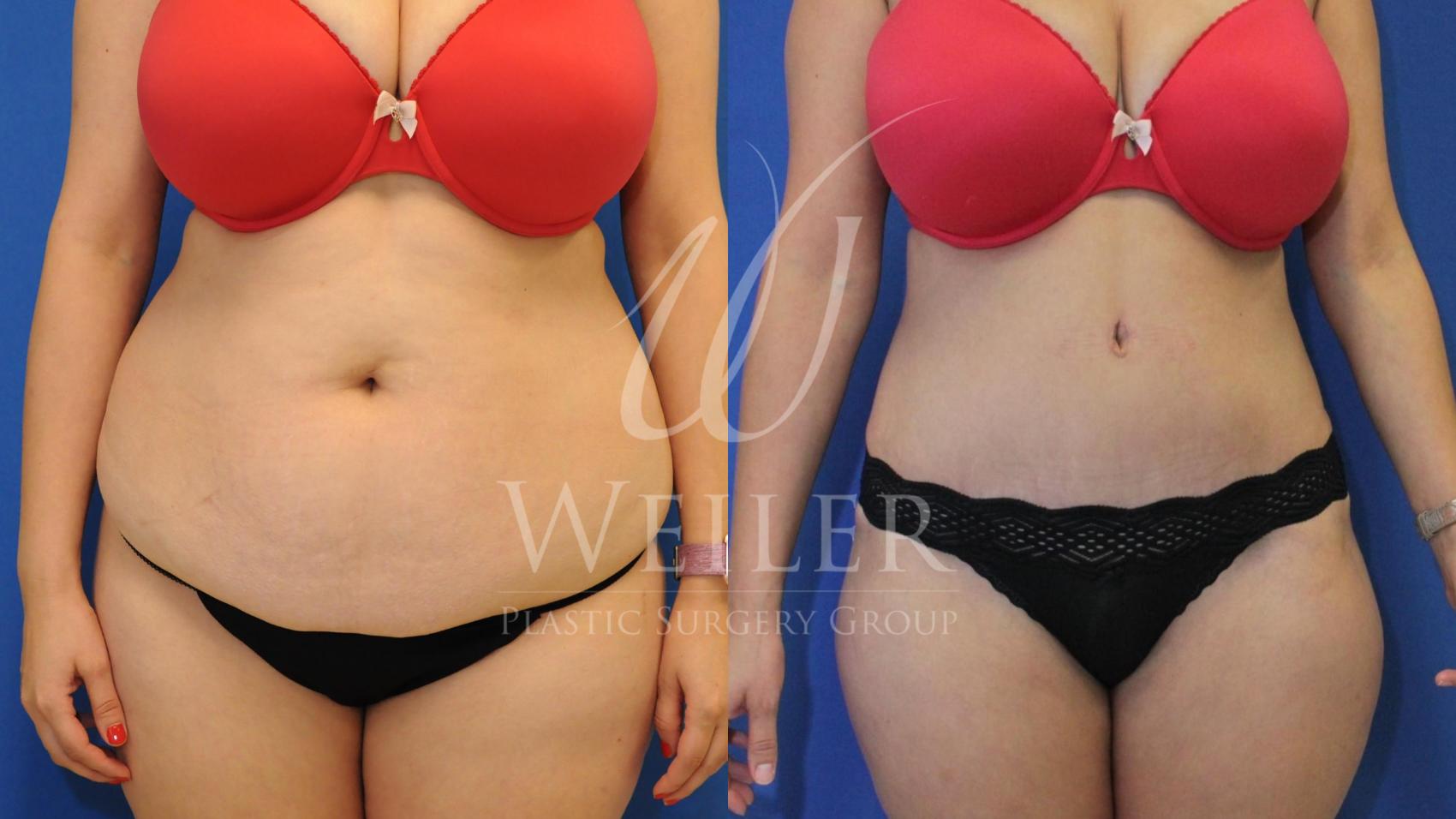 Before & After Tummy Tuck Case 461 View #1 View in Baton Rouge, Louisiana